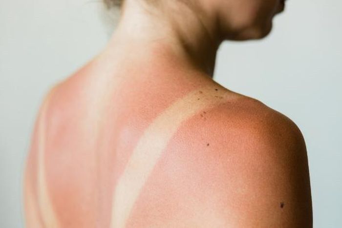 Tia UV gây lão hóa da sớm và làm suy giảm collagen rõ rệt