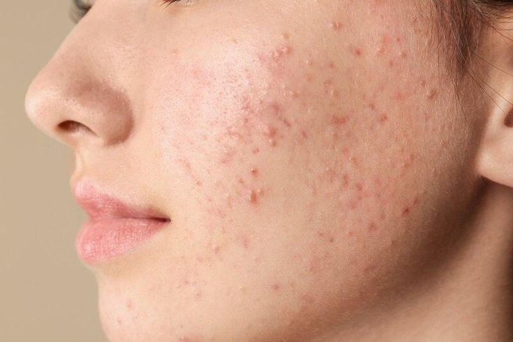 Cách chăm sóc da nhạy cảm đúng cách giúp da khỏe mạnh