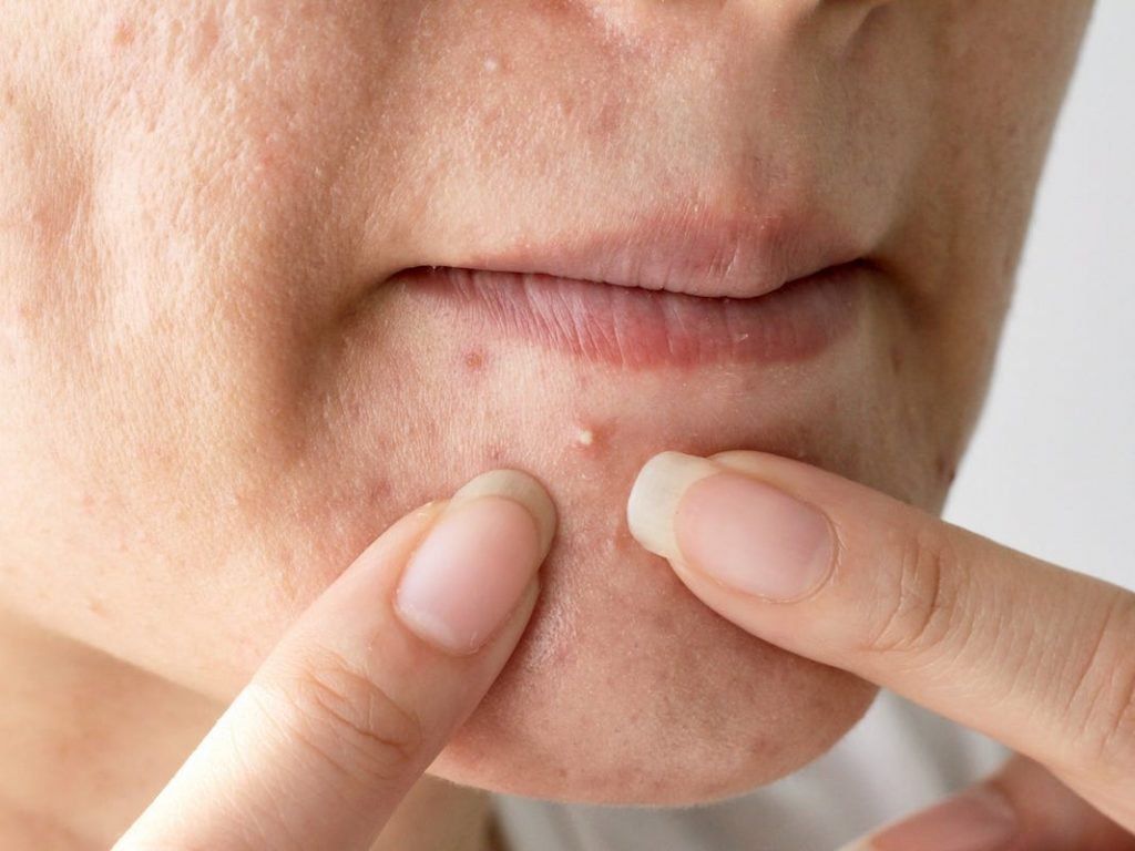Miếng dán mụn phù hợp nhất với mụn mủ nông, mụn có đầu trắng hoặc nốt mụn đang tiết dịch