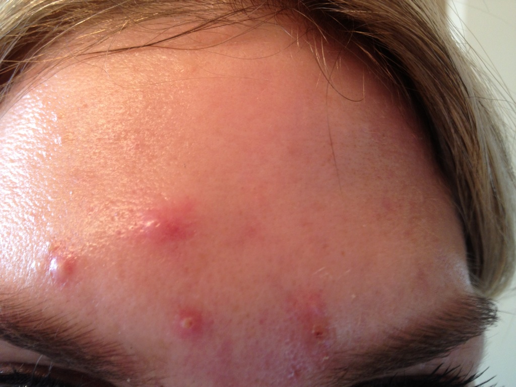 Mụn bọc, mụn nang và mụn viêm sâu là nhóm dễ để lại sẹo hơn trên da