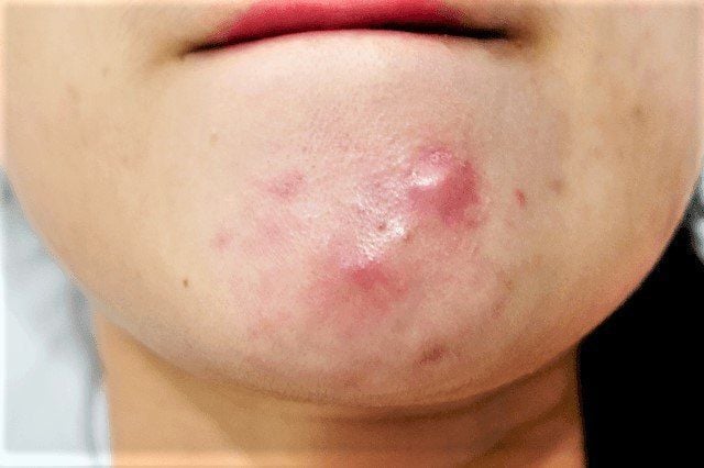 Mụn do PCOS thường mọc ở cằm, đường viền hàm và khó điều trị dứt điểm