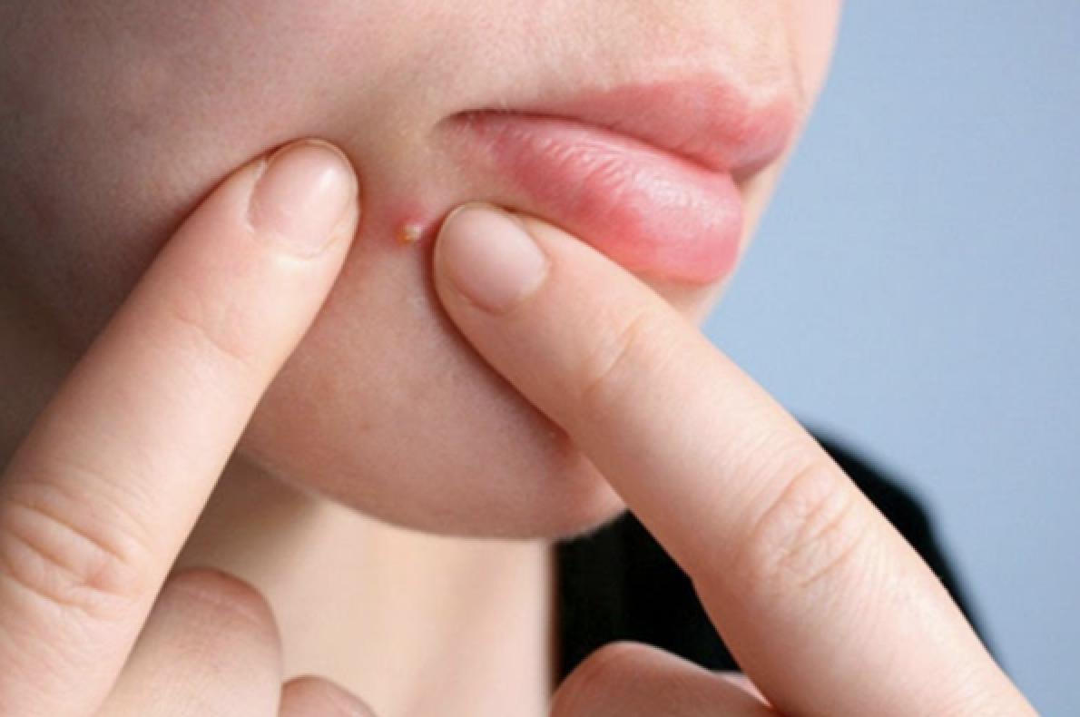 Nặn mụn sai cách làm tăng nguy cơ sẹo và khiến tổn thương da lan rộng hơn