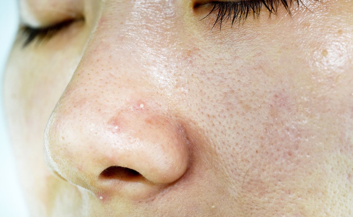 Da dầu và mụn tuổi dậy thì do dầu thừa và tắc lỗ chân lông