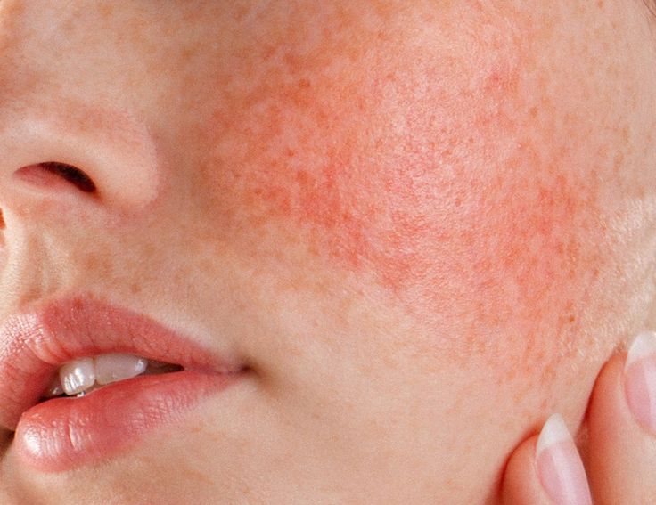 Nguyên nhân gây ra da nhạy cảm và cách phòng tránh