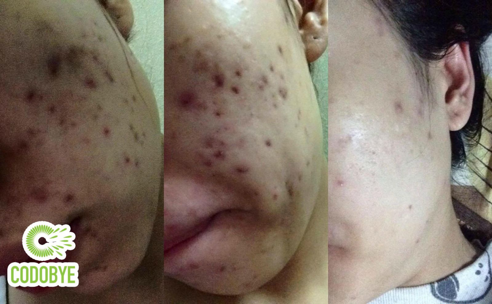 Vết thâm mụn có thể mất nhiều tháng để mờ dần tùy mức độ viêm và cách chăm sóc da