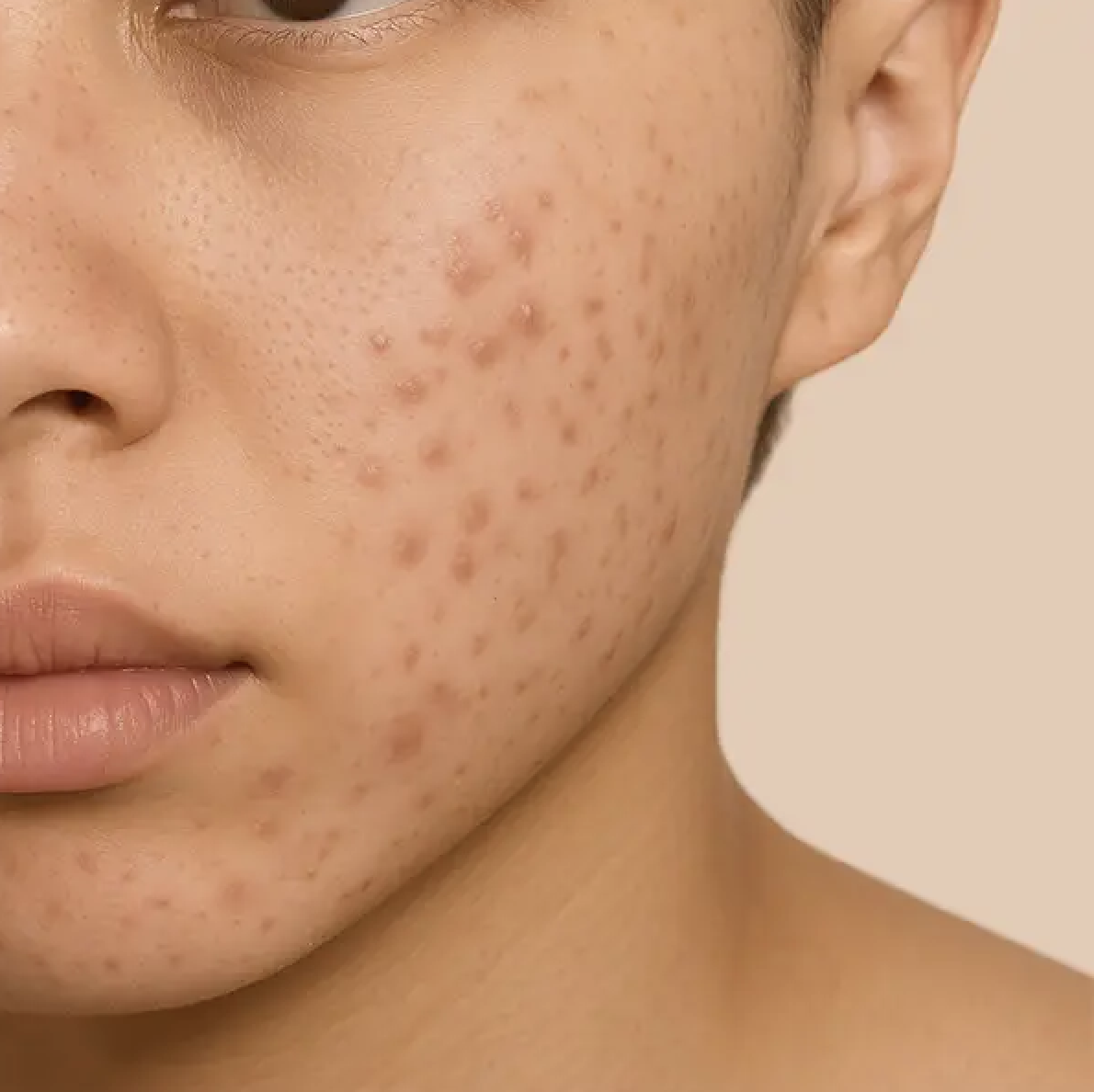 Thâm mụn và bề mặt da không mịn là lý do khiến da chưa đẹp lên sau khi hết mụn