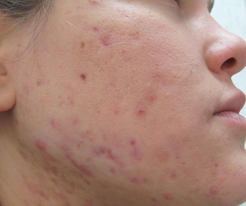 Vết thâm mụn lâu mờ do tăng sắc tố sau viêm trên da mặt