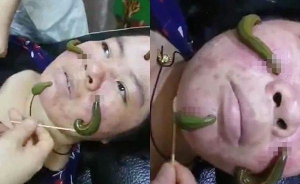 Người phụ nữ Trung Quốc sử dụng phương pháp y học cổ truyền bằng cách sử dụng các con đỉa xanh bò lên mặt để hút mụn
